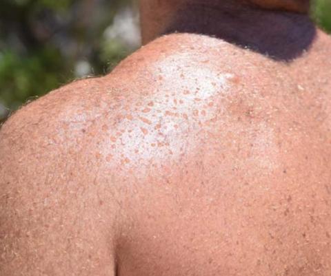 Excessive sweating can lead to loss of hydration or electrolyte imbalances in the body. ALEXANDRIA RANDOLPH | DISPATCH RECORD
