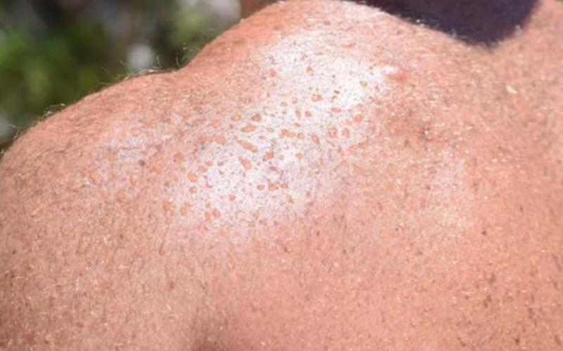 Excessive sweating can lead to loss of hydration or electrolyte imbalances in the body. ALEXANDRIA RANDOLPH | DISPATCH RECORD